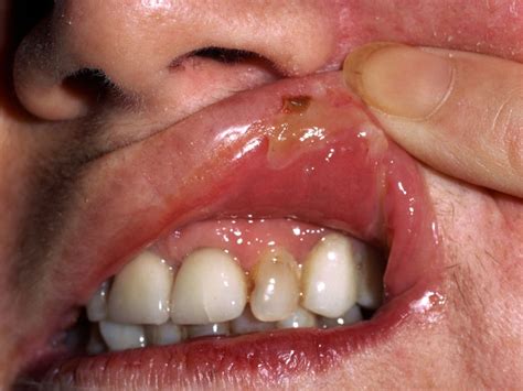 Cheilitis Angularis