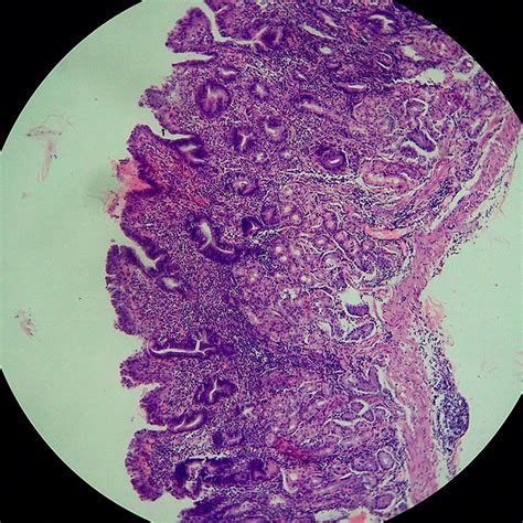 Consult a doctor for medical advice. Gastritis atrófica: qué es, causas, síntomas y tratamiento ...