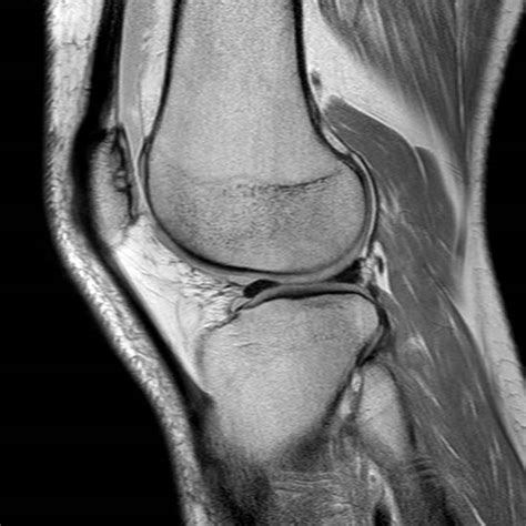 Imagenes De Resonancia Magnetica De Rodilla