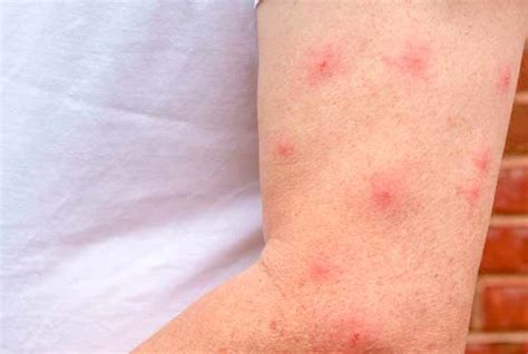 Mosquito Bite Vs Spider Bite Differences And Similarities Pestbugs