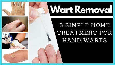 Wart Removal 3 Simple Home Treatments For Hand Warts 2018 Youtube