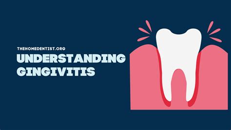 Understanding And Treating Gingivitis Your Ultimate Guide The Home