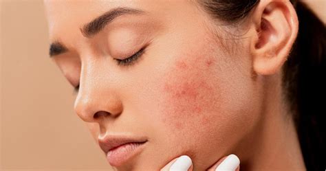 The 7 Types Of Pimples On The Face And How To Treat Them 【 2024