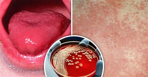 Scarlet Fever Symptoms Learn The Signs Of Highly Contagious Bug As