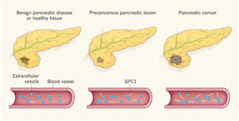 Most pancreatic cancer begins in the cells that line the ducts of the pancreas. Possible Diagnostic Marker for Pancreatic Cancer ...