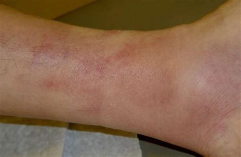 Superficial Thrombophlebitis Pictures Symptoms And Pictures