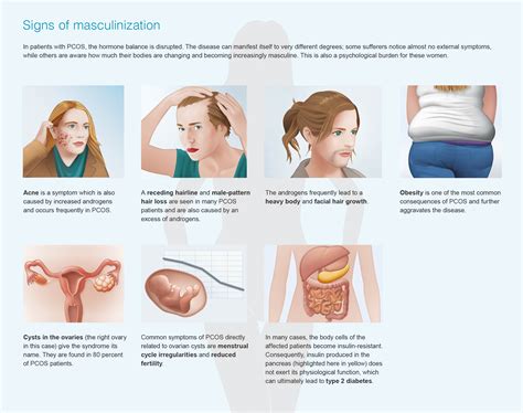 I thought i'd do some research and share it with you so we can all benefit! All You Need To Know About PCOS | Health By Arv