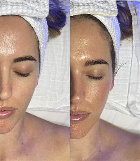 HydraFacial Before And After Photo Gallery Chico Yuba City Oroville CA Hodari MD