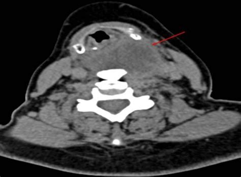 Neck Ct Axial Scan Showing Suppurated Diverticulum At The Level Of