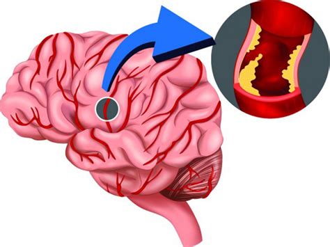 A stroke is a medical condition in which poor blood flow to the brain causes cell death. Reducing incidence of stroke with thrombolytics ...