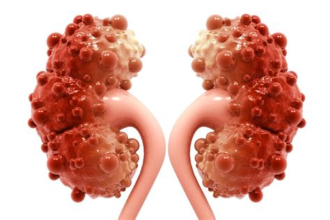 Evaluation of acute renal colic: Poliquistosis renal autosómica dominante - Nefrologos en ...