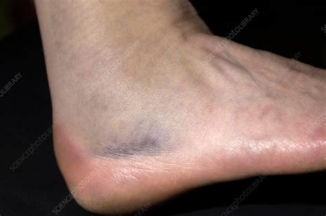 I laughed out loud when i saw their group.' no wonder holly never went back. Fractured ankle bone - Stock Image - M330/1442 - Science Photo Library