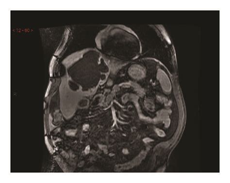 Ct Scan And Mri Imaging Of The Liver Lesions A Ct Scan Coronal