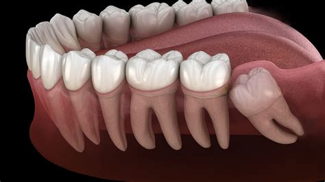 Maybe you would like to learn more about one of these? What to Expect After a Wisdom Tooth Extraction - Smile ...