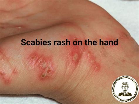 What Does Scabies Look Like Images Education Nigeria