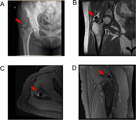 Frontiers Endoscopic Treatment For Calcific Tendinitis Of The Gluteus Medius A Case Report