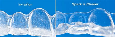 Spark Vs Invisalign The Best Clear Aligners Compared