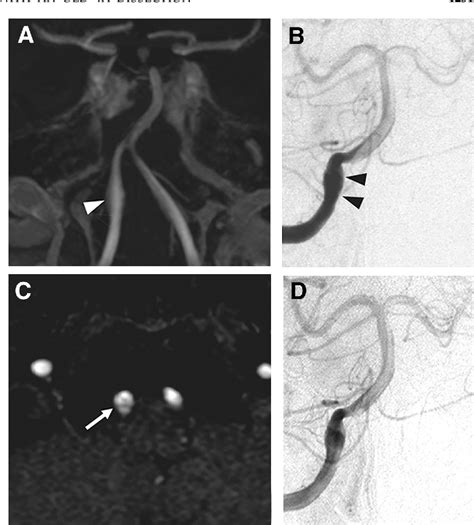 Figure From Simultaneous Onset Of Anterior And Middle Cerebral Artery Dissections With An Old