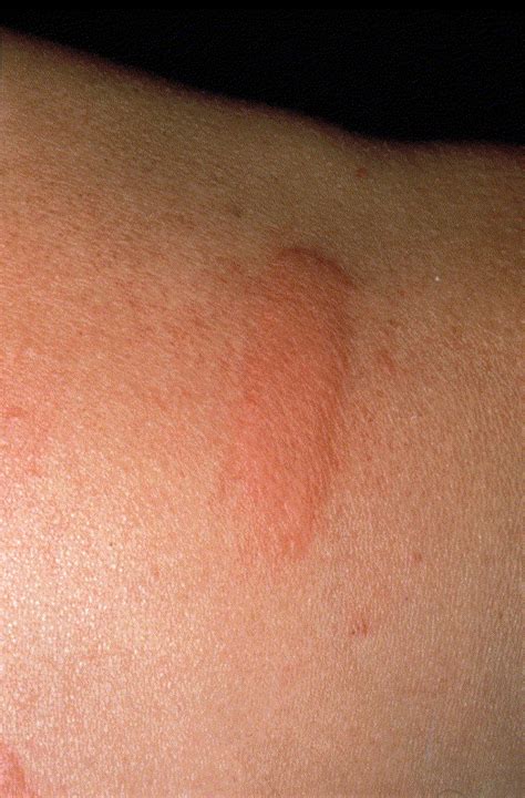 Delayed Pressure Urticaria Immunology And Allergy Clinics