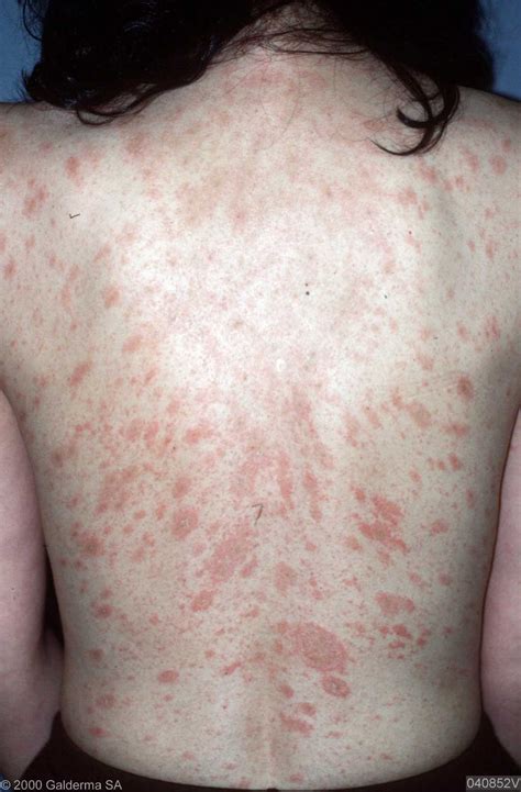 This is then followed, days to weeks later, by a rash of many similar but smaller round or oval lesions, mainly on the trunk and upper limbs. Pityriasis-rosea-blanke-huid - Huidarts.com