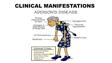 Addisons Disease And Its Management