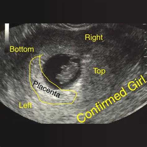 Ultrasound Scan Baby Gender Pictures Ababyw