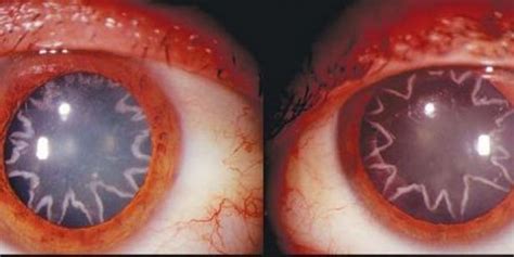 Determining your face shape is as easy as 1, 2, 3 — literally. 14,000 Volts Of Electricity Left This Man's Cataracts ...