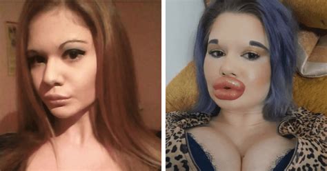 Andrea Ivanova Woman With Biggest Lips In The World Slammed Over 27th Filler Injection Meaww