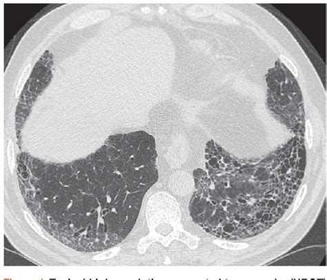 Figure 1 From Recent Advances In Understanding Idiopathic Pulmonary