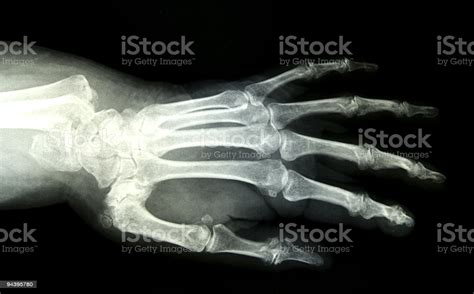 Broken Wrist Hand Xray Stock Photo Download Image Now