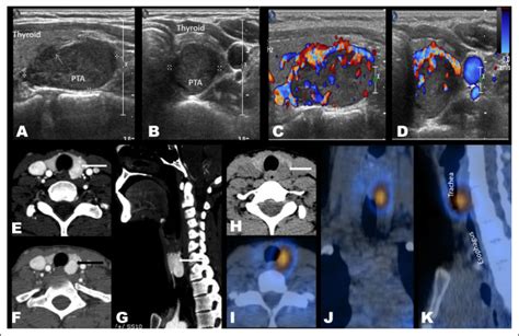 Imaging Localization And Surgical Approach In The Management Of Ectopic