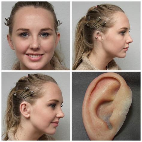 Microtia Ear Prosthetics Feel More Confident And Comfortable