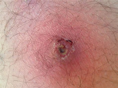 The venom from a black widow spider is poisonous. Black widow spider bite pictures day 1, brown tick bite ...