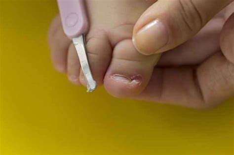 Memberikan bayi asi menyusui dapat menjadi salah satu cara mengatasi cegukan bayi anda. Bisa Dilakukan di Rumah, Begini Cara Atasi Kuku Cantengan ...