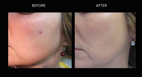 Rosacea Treatments In Kelowna By Dermmedica