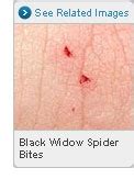 The black widow spider bite symptoms are a result of the venom which contains protein that can considerably influence the nervous system of the bitten individual. Black widow spider bite symptoms | Reference | Pinterest