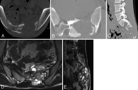 Serial Endovascular Embolization As Stand Alone Treatment Of A Sacral
