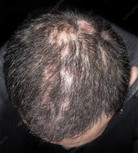 Cystic Acne And Dissecting Folliculitis Stock Image C0180328