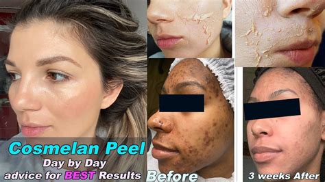 Cosmelan Peel Skin Expert Secrets To Correct Skin Recovery And Best