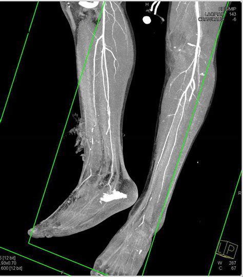 Open Tibial Fracture With Vascular Injury Trauma Case Studies
