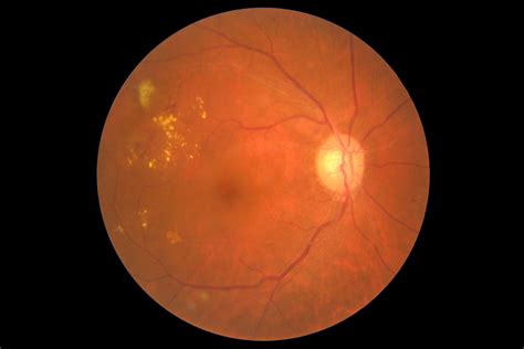 Macular Edema Eye Patient