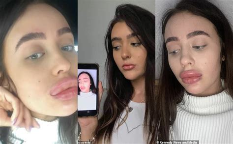 lady s lips triple in size after botched lip filler treatment photos theinfong