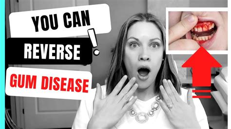 How To Reverse Gum Disease At Home YouTube