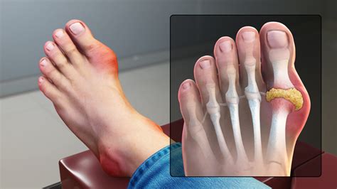 Gout In Big Toe How To Identify Causes And Treatment 2023