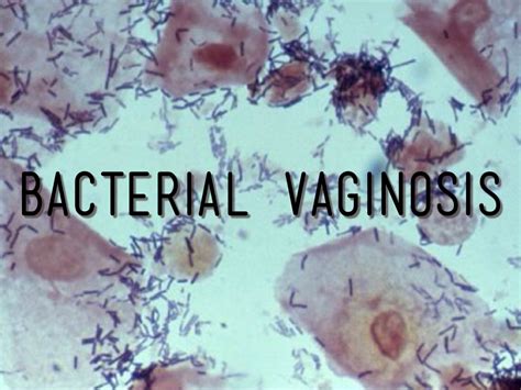 Bacterial Vaginosis By Lauren Hall