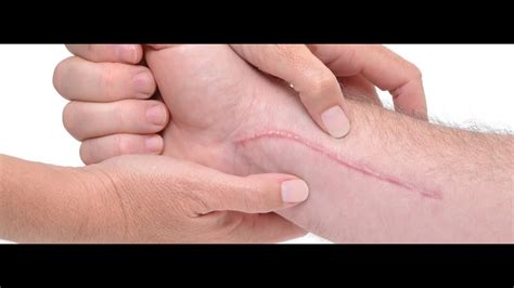 Tips On Management Of Scar Tissue Youtube