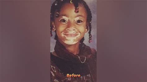 Winnie Harlow Before After Youtube