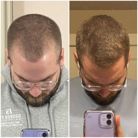 Second shed but different? Different hairs shed than before : r/tressless