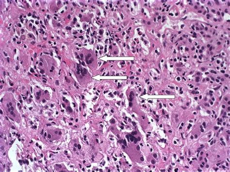 Giant Cell Hepatitis In A Teenage Woman Clinical Gastroenterology And