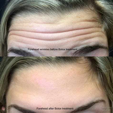 Botox Before And After Pictures Deep Forehead Wrinkle Lips